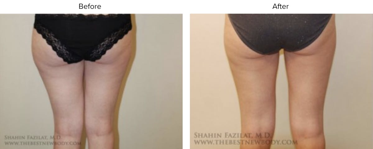 Liposuction Before & After Gallery - Patient 284255 - Image 2
