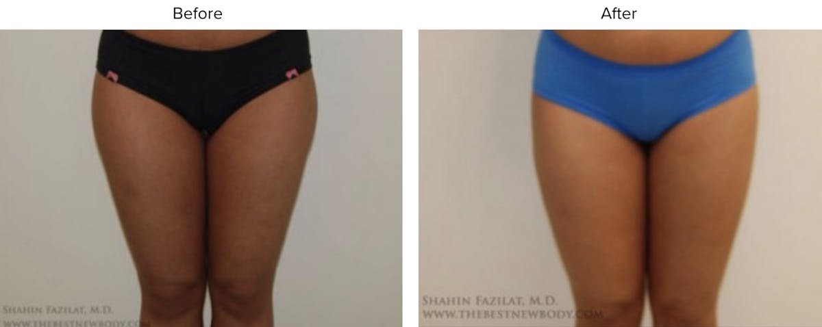 Liposuction Before & After Gallery - Patient 731371 - Image 1
