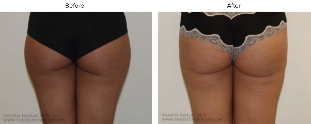 Liposuction Before & After Gallery - Patient 153062 - Image 1