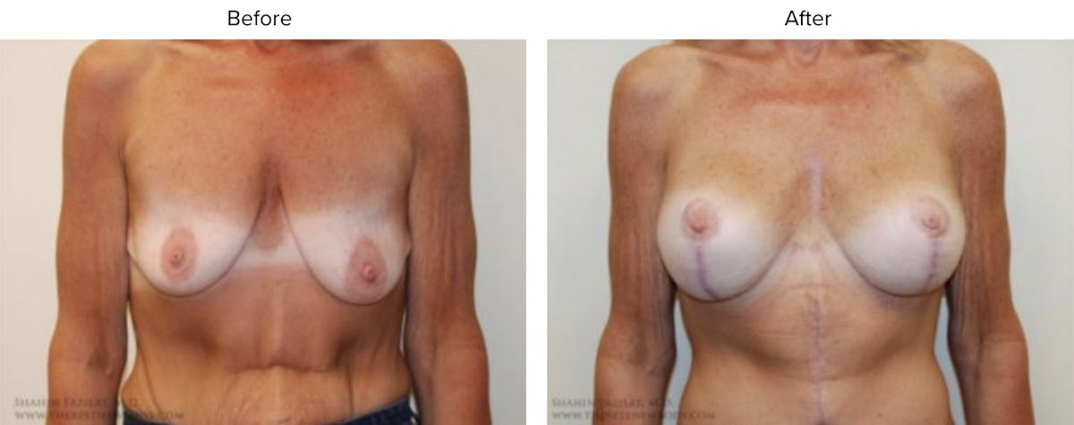 Liposuction Before & After Gallery - Patient 247074 - Image 1