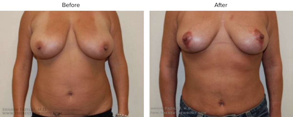 Liposuction Before & After Gallery - Patient 469115 - Image 1