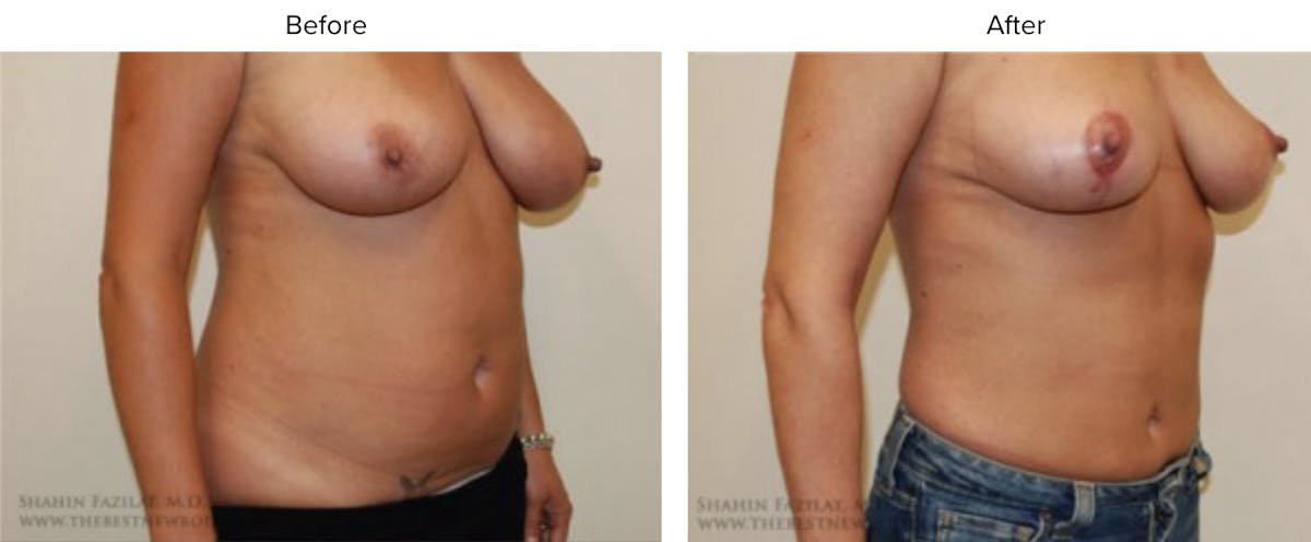 Liposuction Before & After Gallery - Patient 267924 - Image 1