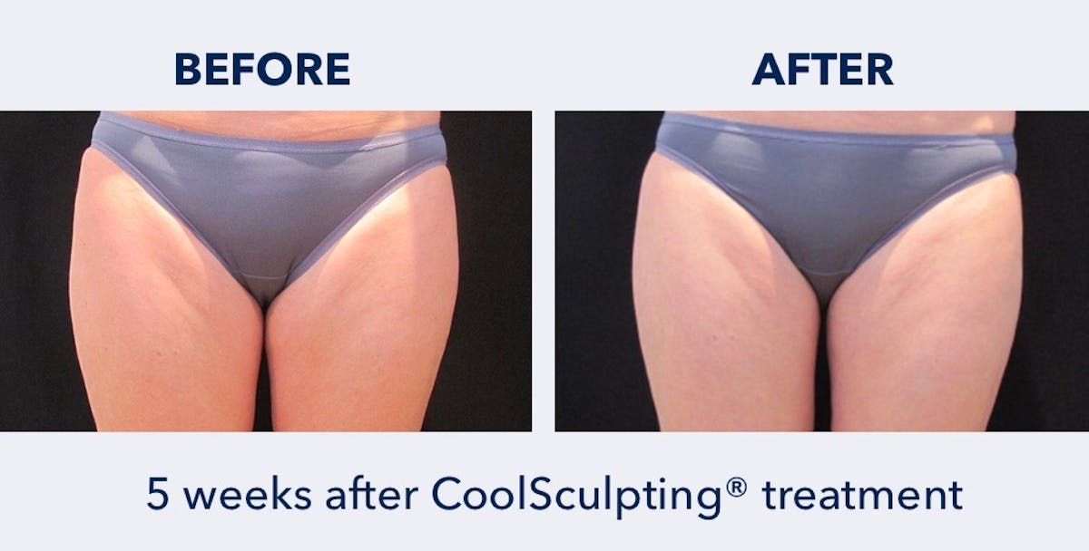 CoolSculpting Before & After Gallery - Patient 139146 - Image 1
