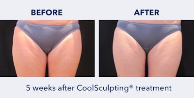 CoolSculpting Before & After Gallery - Patient 139146 - Image 1
