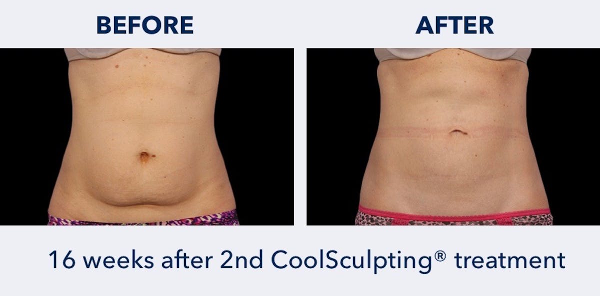 CoolSculpting Before & After Gallery - Patient 363752 - Image 1