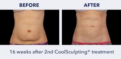 CoolSculpting Before & After Gallery - Patient 363752 - Image 1