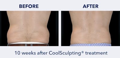 CoolSculpting Before & After Gallery - Patient 120823 - Image 1