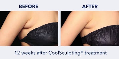 CoolSculpting Before & After Gallery - Patient 164497 - Image 1