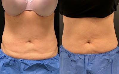 CoolSculpting Before & After Gallery - Patient 103828 - Image 1