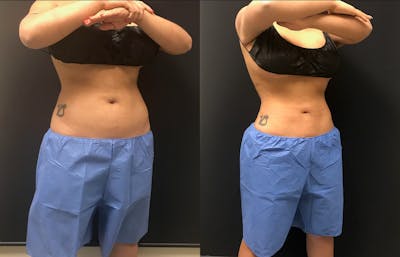 CoolSculpting Before & After Gallery - Patient 312179 - Image 1
