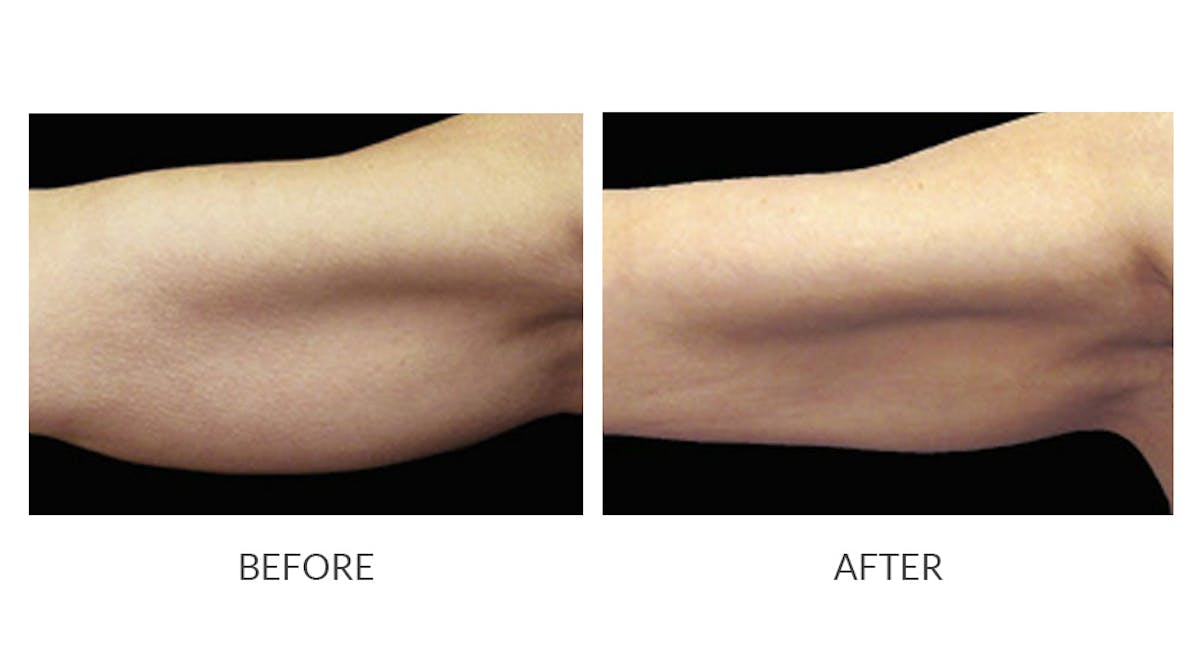 CoolSculpting Before & After Gallery - Patient 390764 - Image 1