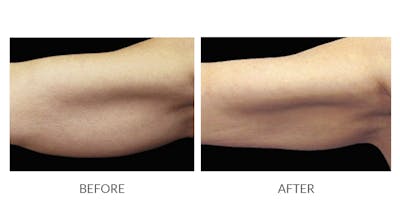 CoolSculpting Before & After Gallery - Patient 390764 - Image 1