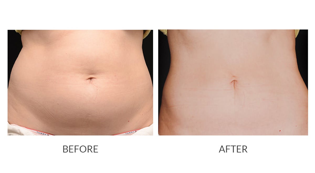 CoolSculpting Before & After Gallery - Patient 289011 - Image 1