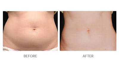 CoolSculpting Before & After Gallery - Patient 289011 - Image 1