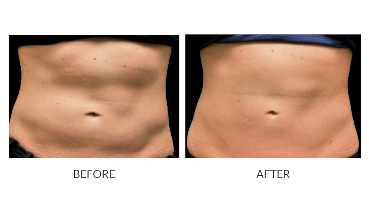 CoolSculpting Before & After Gallery - Patient 217331 - Image 1