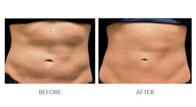 CoolSculpting Before & After Gallery - Patient 217331 - Image 1