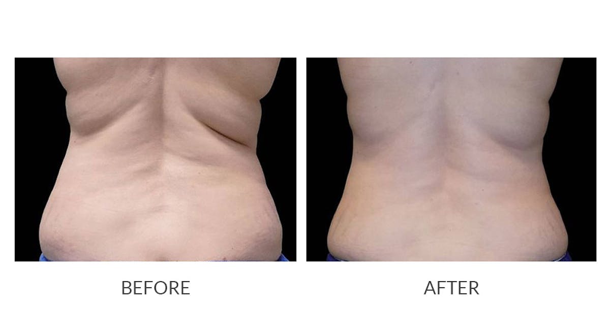 CoolSculpting Before & After Gallery - Patient 997319 - Image 1