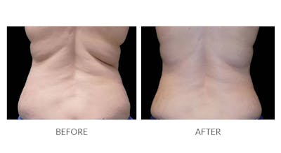 CoolSculpting Before & After Gallery - Patient 997319 - Image 1