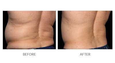 CoolSculpting Before & After Gallery - Patient 153271 - Image 1