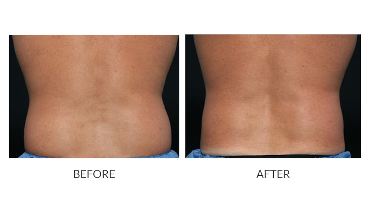 CoolSculpting Before & After Gallery - Patient 321837 - Image 1