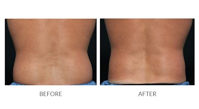 CoolSculpting Before & After Gallery - Patient 321837 - Image 1