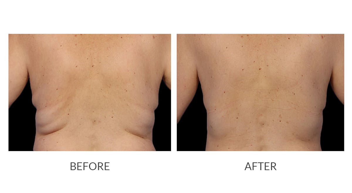 CoolSculpting Before & After Gallery - Patient 323384 - Image 1