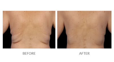 CoolSculpting Before & After Gallery - Patient 323384 - Image 1
