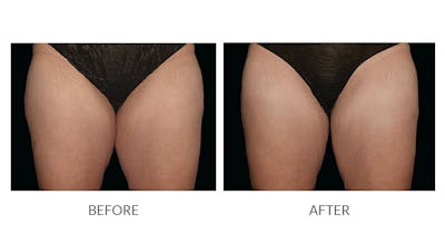 CoolSculpting Before & After Gallery - Patient 164867 - Image 1