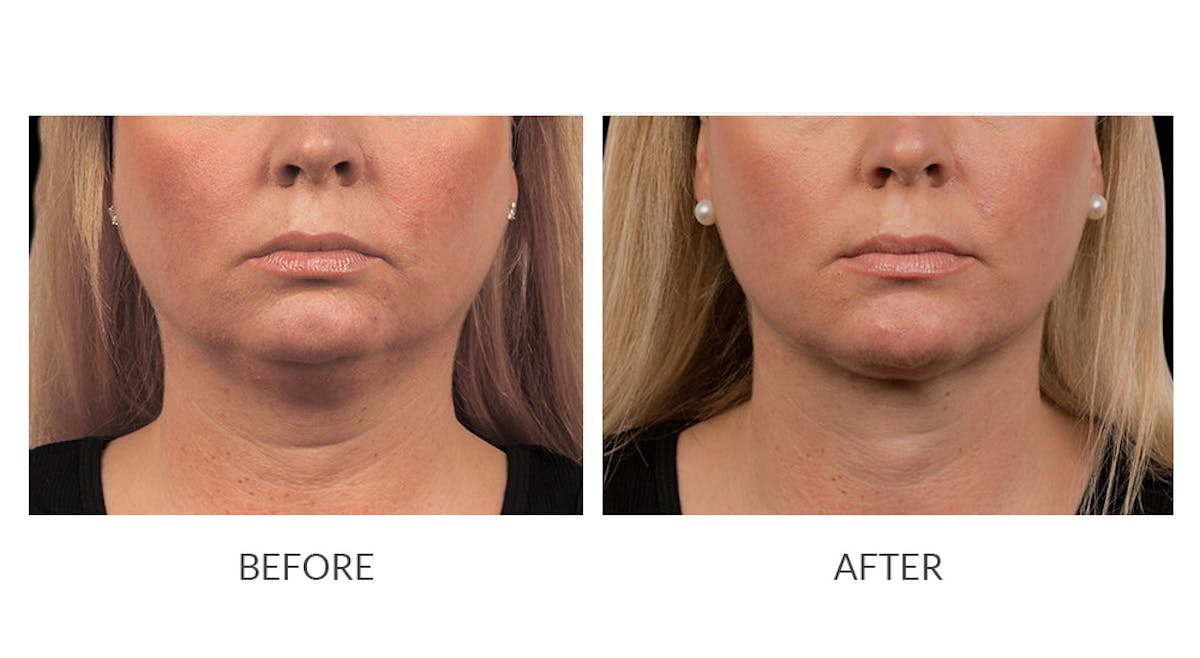 CoolSculpting Before & After Gallery - Patient 325715 - Image 1