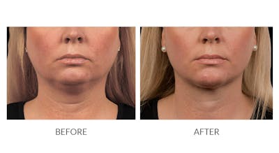 CoolSculpting Before & After Gallery - Patient 325715 - Image 1