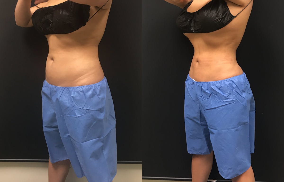 CoolSculpting Before & After Gallery - Patient 312179 - Image 2