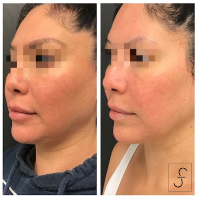BodyTite and FaceTite Before & After Gallery - Patient 222330 - Image 1