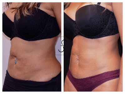 BodyTite and FaceTite Before & After Gallery - Patient 197283 - Image 1