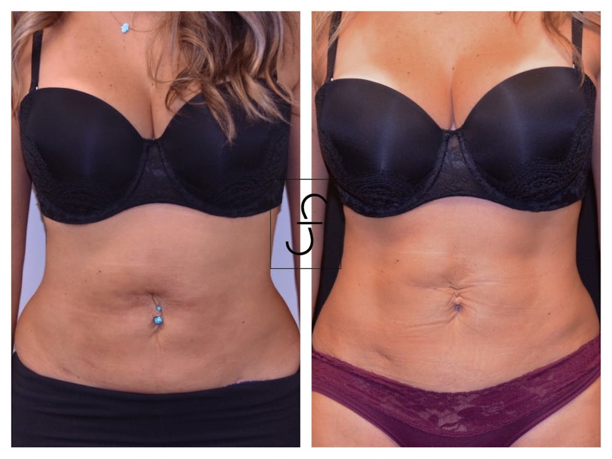 BodyTite and FaceTite Before & After Gallery - Patient 197283 - Image 2