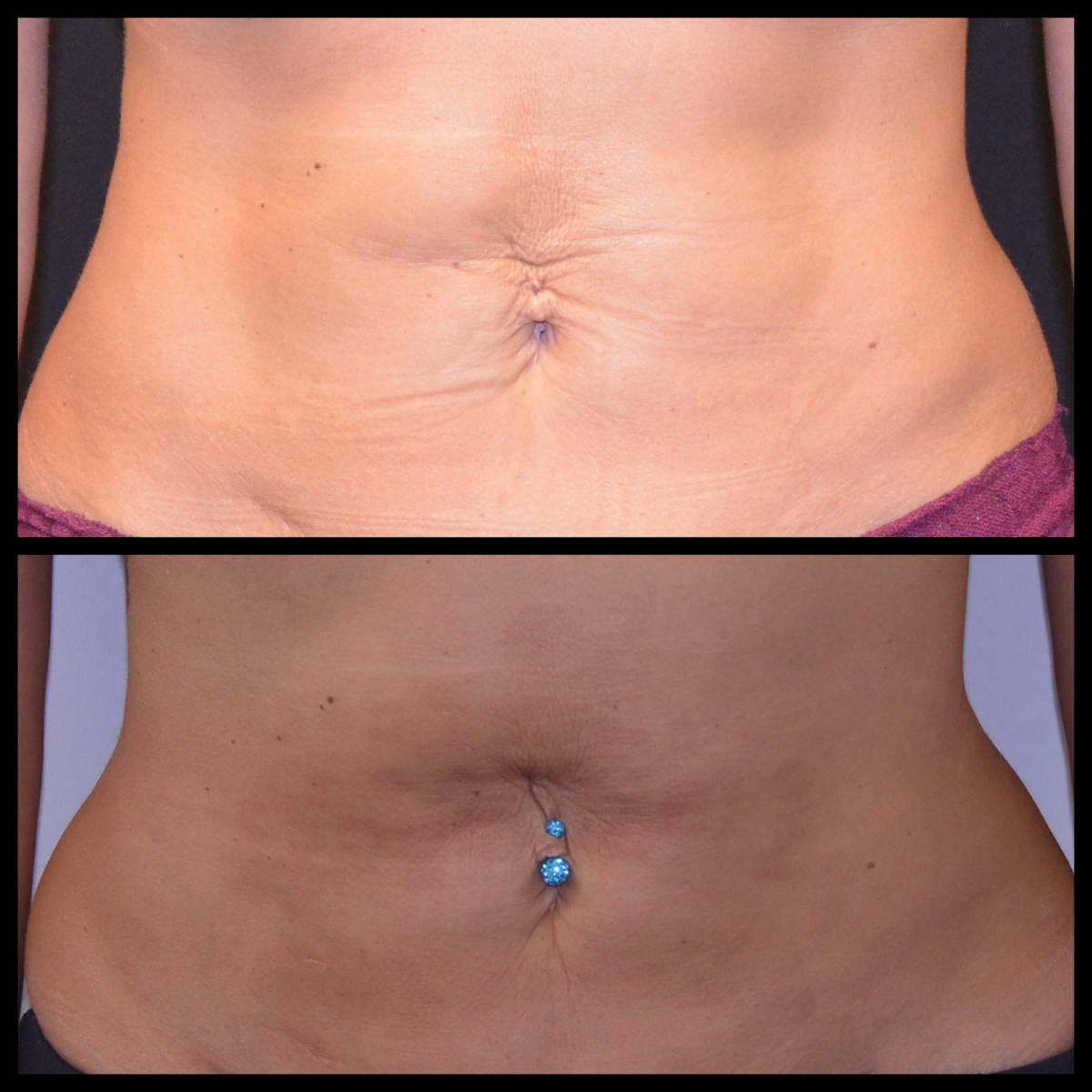 BodyTite and FaceTite Before & After Gallery - Patient 207553 - Image 1