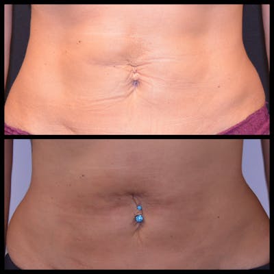 BodyTite and FaceTite Before & After Gallery - Patient 207553 - Image 1