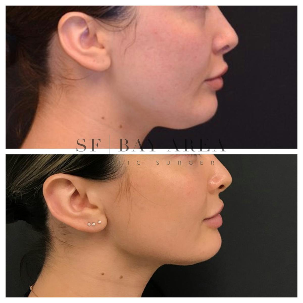 BodyTite and FaceTite Before & After Gallery - Patient 193443 - Image 1