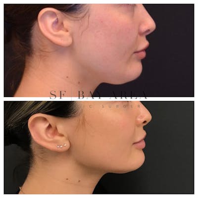 BodyTite and FaceTite Before & After Gallery - Patient 193443 - Image 1