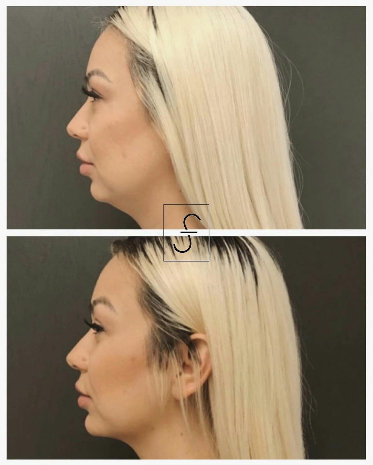 BodyTite and FaceTite Before & After Gallery - Patient 401510 - Image 1