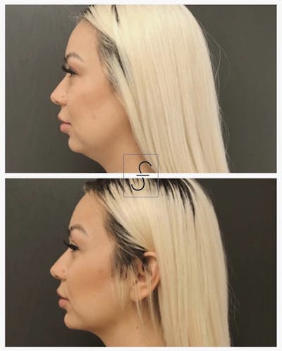 BodyTite and FaceTite Before & After Gallery - Patient 401510 - Image 1