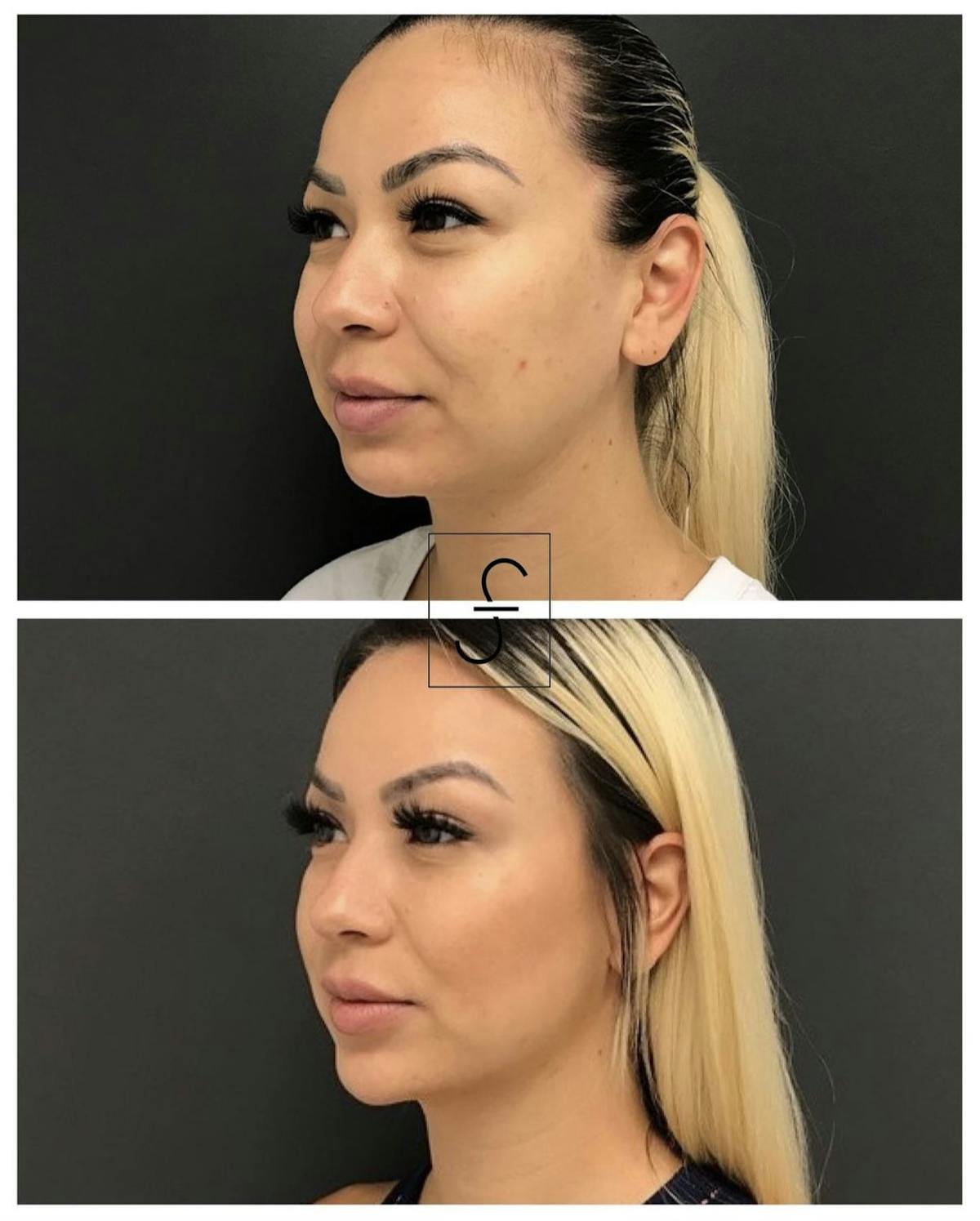 BodyTite and FaceTite Before & After Gallery - Patient 401510 - Image 2