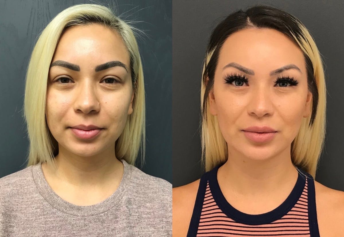 BodyTite and FaceTite Before & After Gallery - Patient 401510 - Image 3