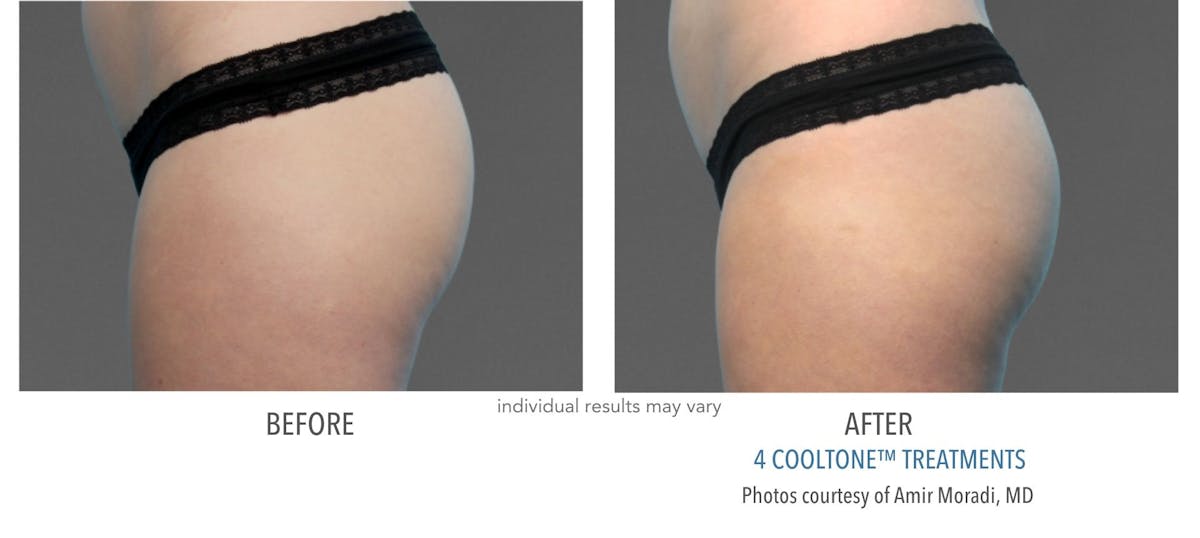 Cooltone Before & After Gallery - Patient 145321 - Image 1