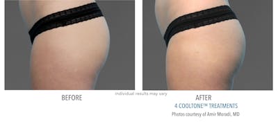Cooltone Before & After Gallery - Patient 145321 - Image 1