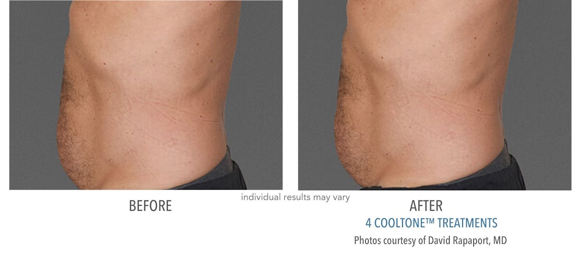 Cooltone Before & After Gallery - Patient 332566 - Image 1