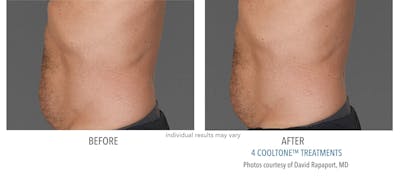 Cooltone Before & After Gallery - Patient 332566 - Image 1