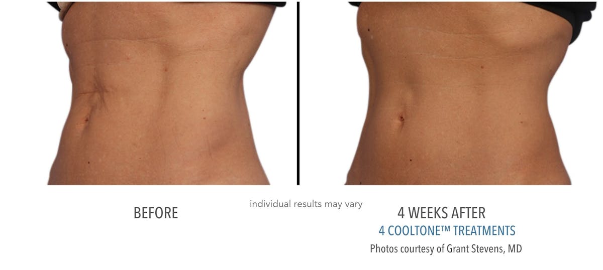 Cooltone Before & After Gallery - Patient 739716 - Image 1