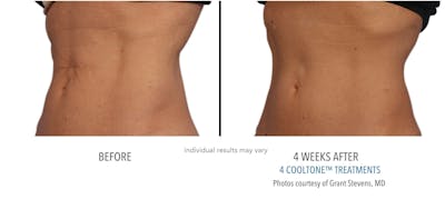 Cooltone Before & After Gallery - Patient 739716 - Image 1