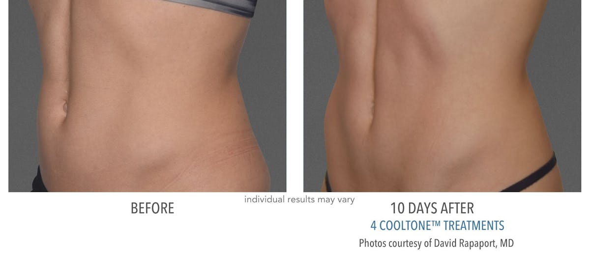 Cooltone Before & After Gallery - Patient 114823 - Image 1