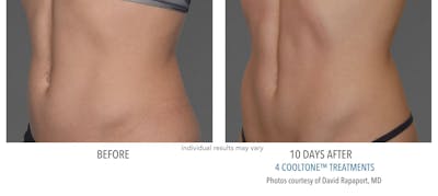 Cooltone Before & After Gallery - Patient 114823 - Image 1